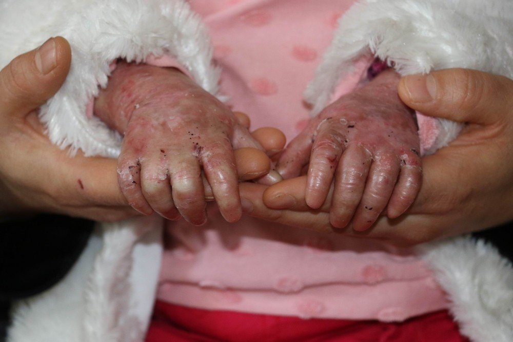 Kelebek hastası çocuklar, kendilerine uygun olmayan köpüklü sargı bezini, derilerine yapıştığı için kullanamıyor