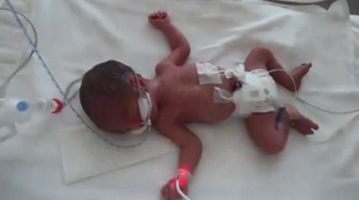 Kayseri Şehir Hastanesi’nin ilk dördüz bebekleri dünyaya geldi