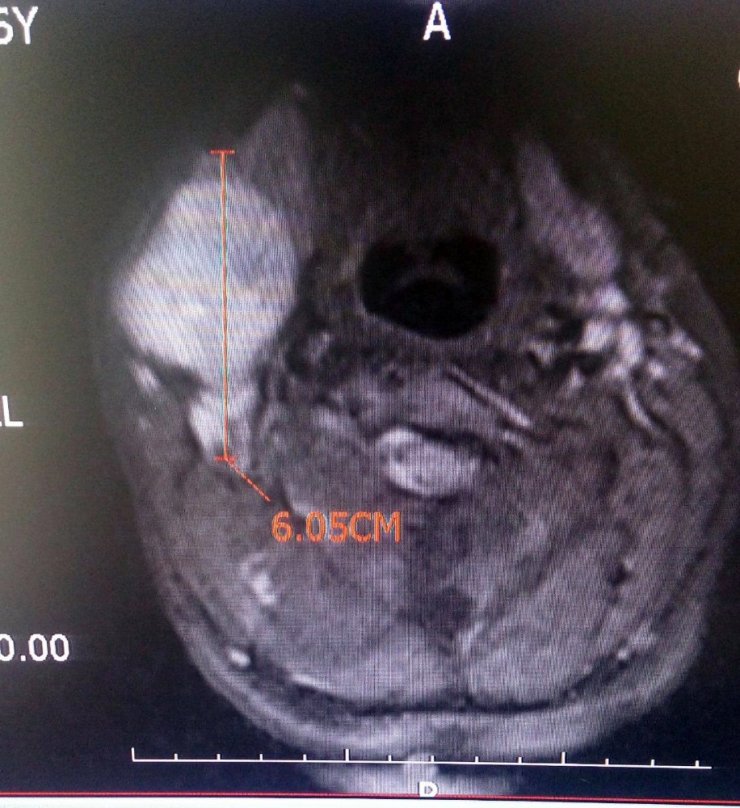 26 yaşındaki engelli hastanın çenesinin altından 38 cm büyüklüğünde tümör çıkarıldı